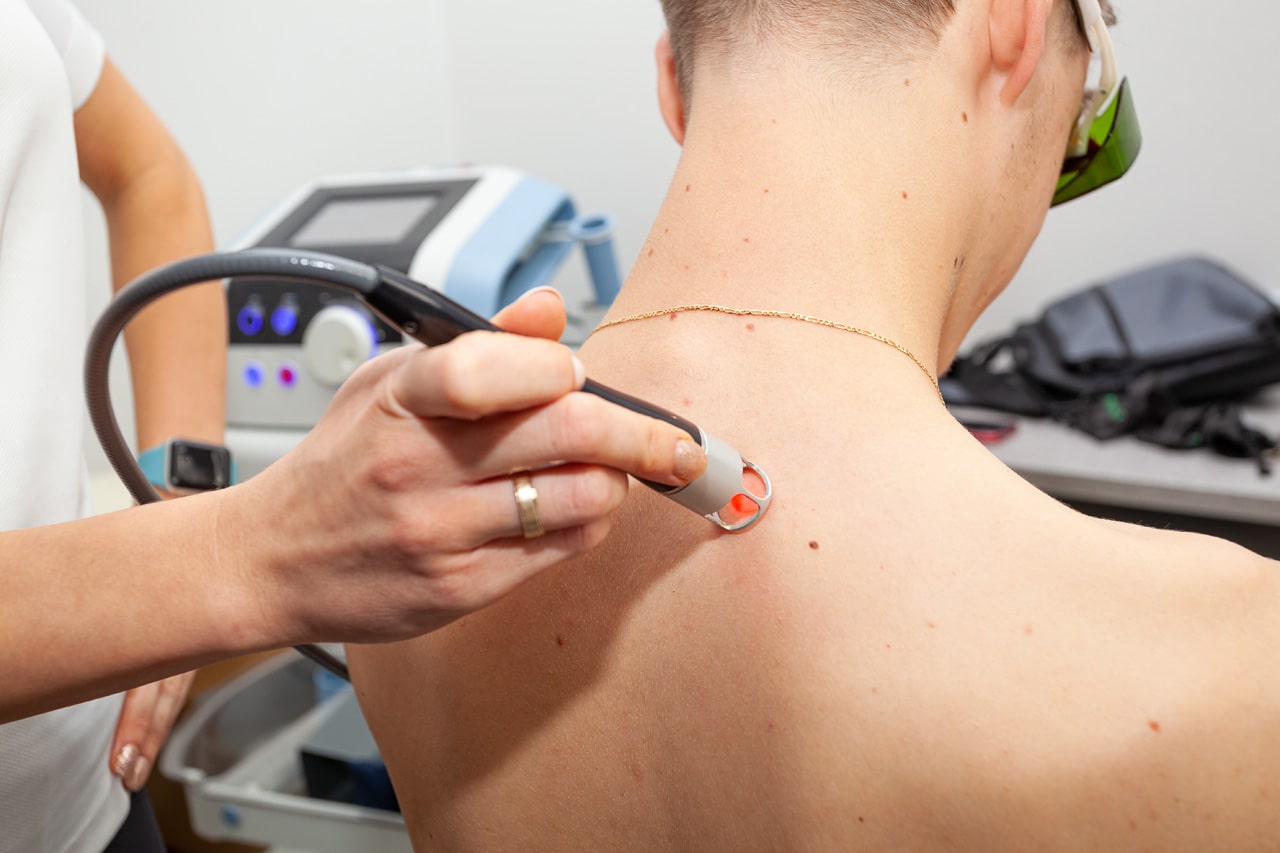 specjalista wykonuje zabieg laserem wysokoenergetycznym na plecach mężczyzny